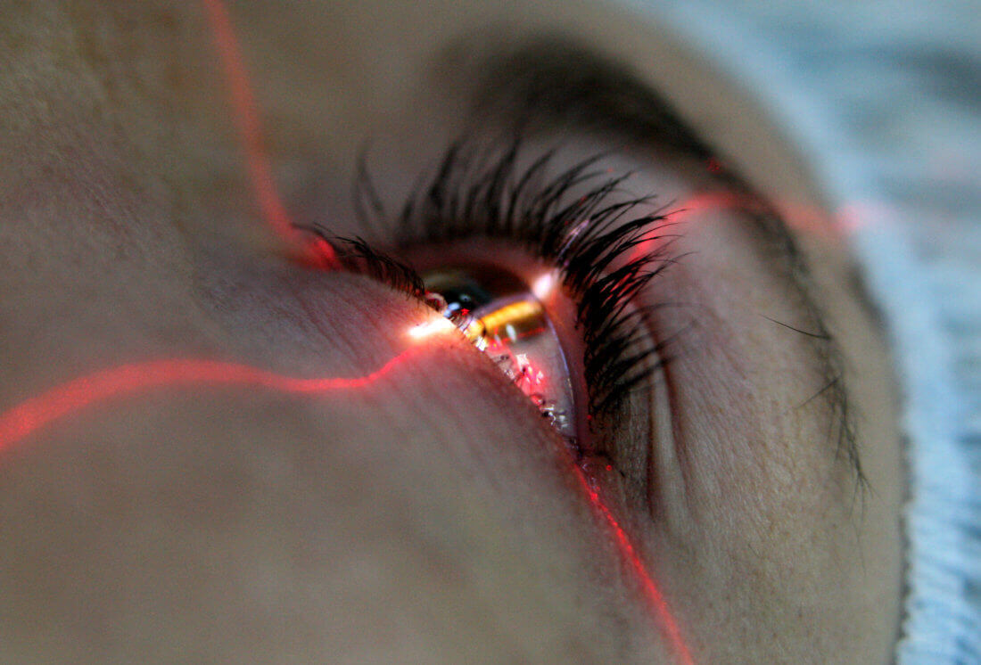 лазерной коррекции зрения