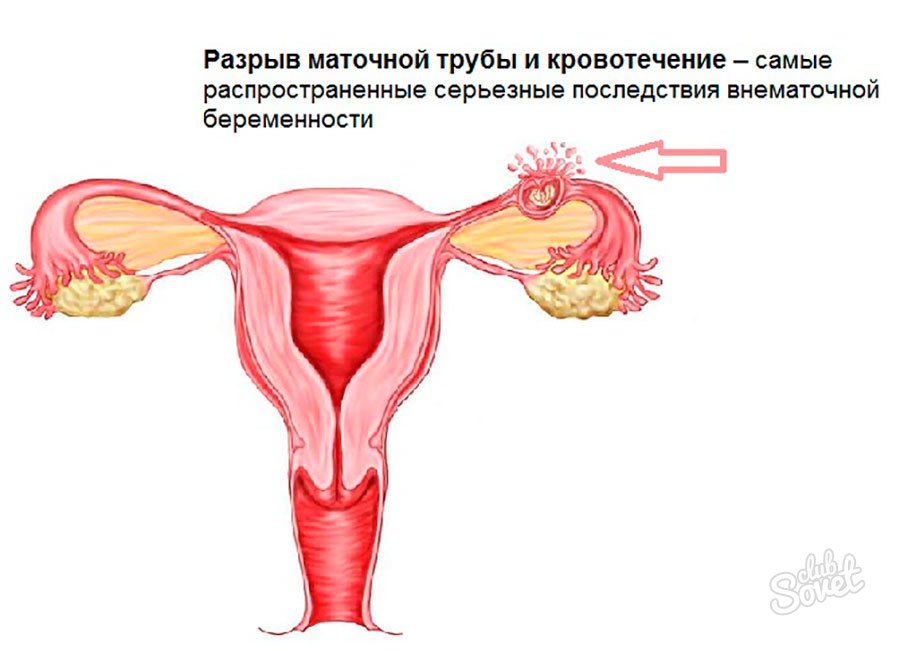 Маточные трубы удаление месячные. Матка внематочная беременность. Эктопическая беременность разрыв маточной трубы. Разрыв маточной трубы при эктопической беременности.